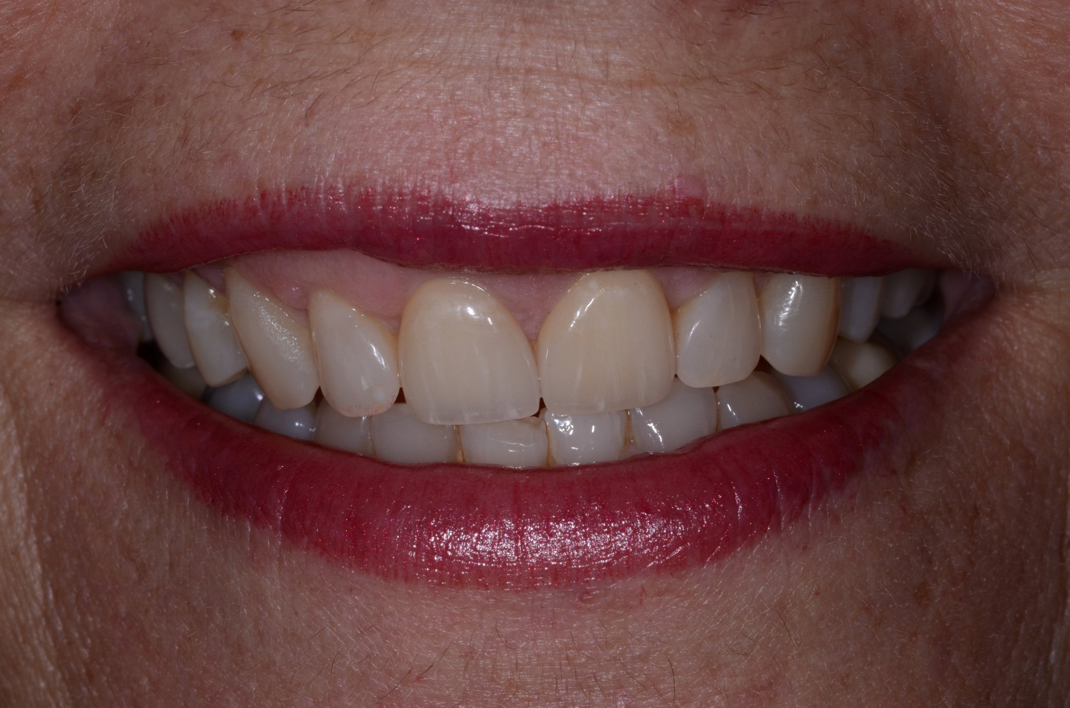 Patient's smile after dental crowns