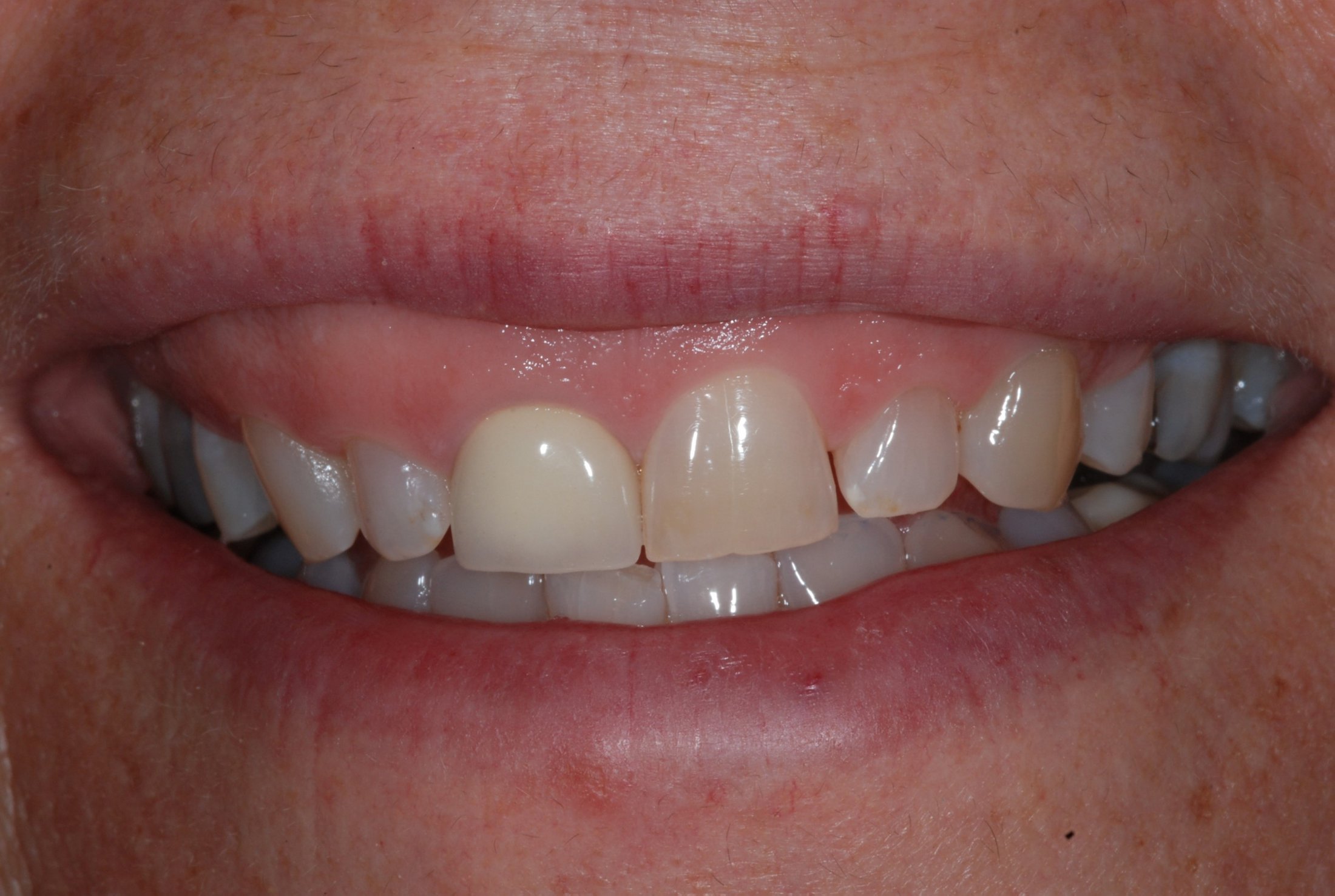 Patient's smile before dental crowns
