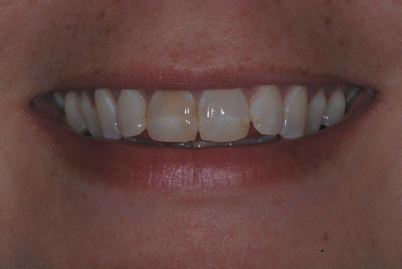 patient's smile before dental treatment