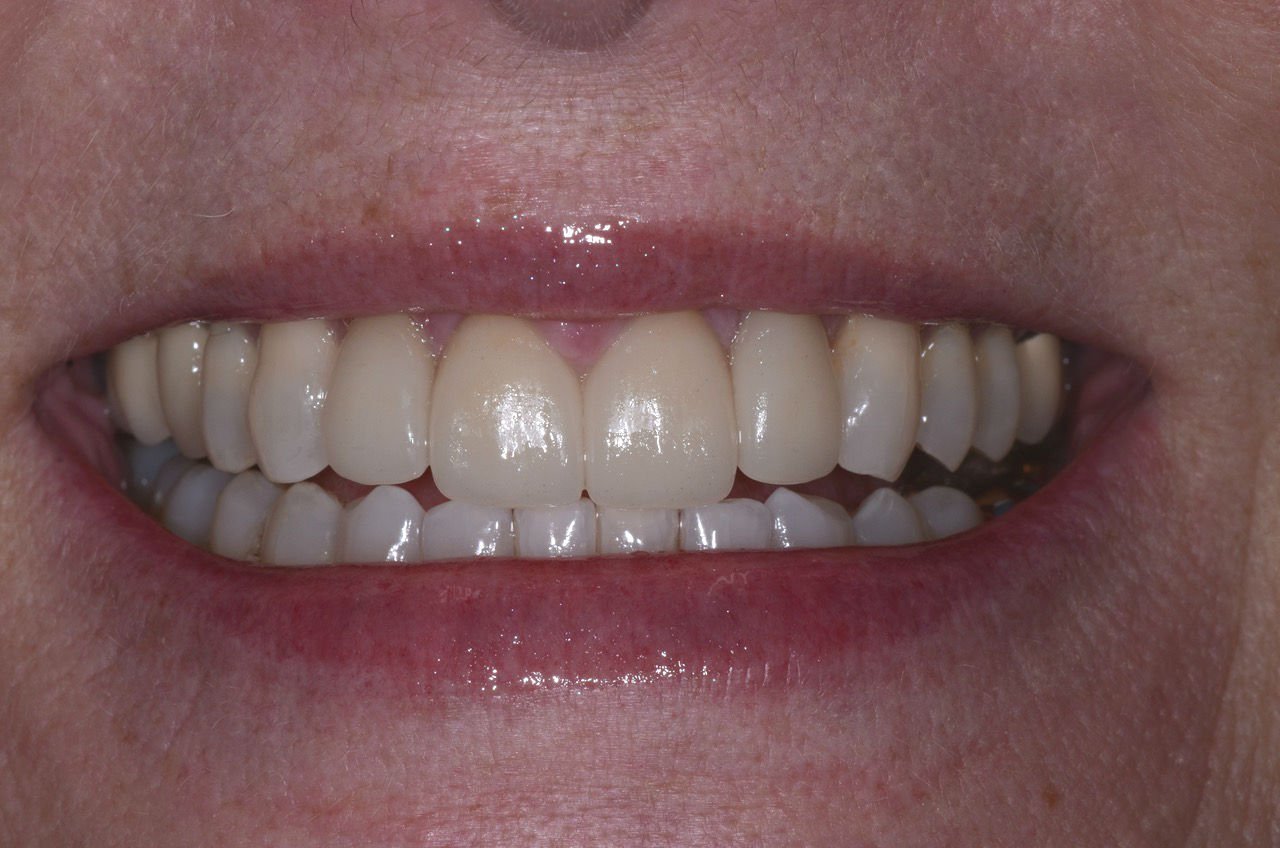 patient's smile after dental treatment