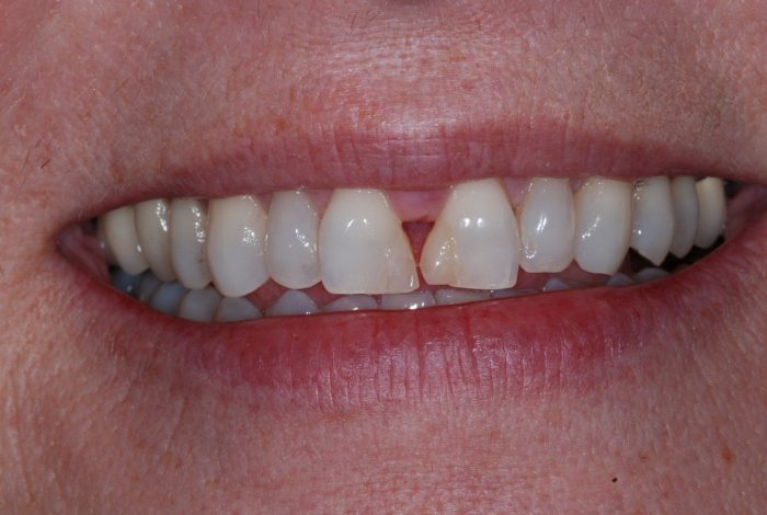 patient's smile before dental treatment