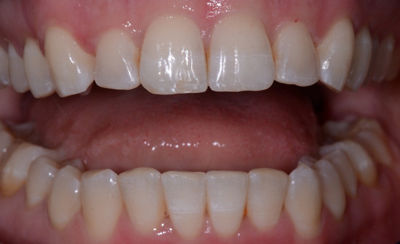 Patient's teeth after Invisalign