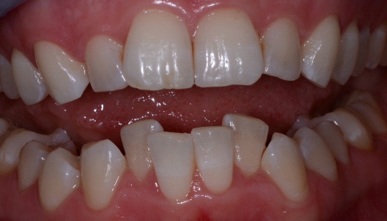 Patient's teeth before Invisalign