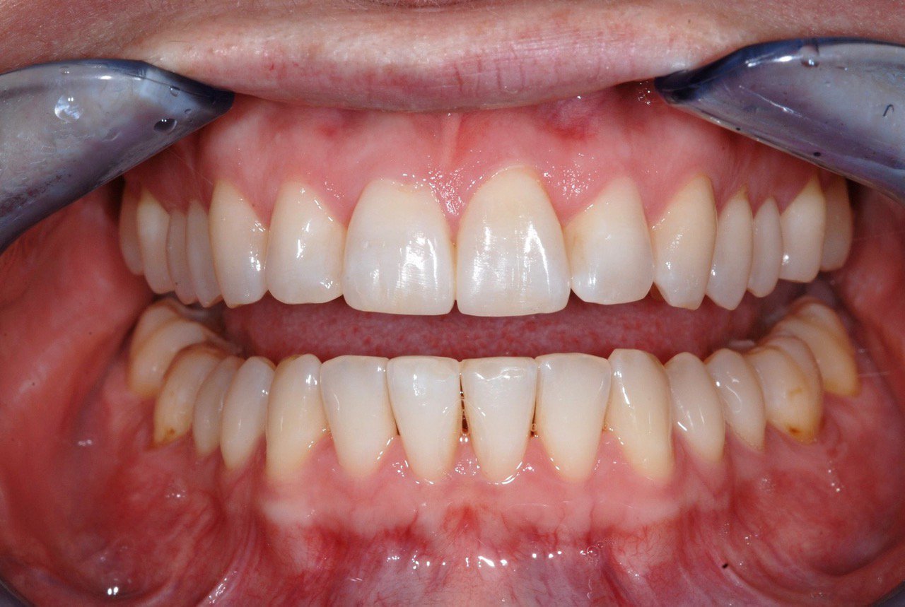 Patient's teeth after Invisalign