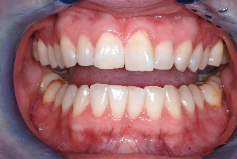 Patient's teeth before Invisalign
