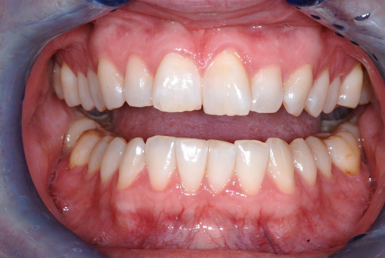 Patient's teeth before Invisalign