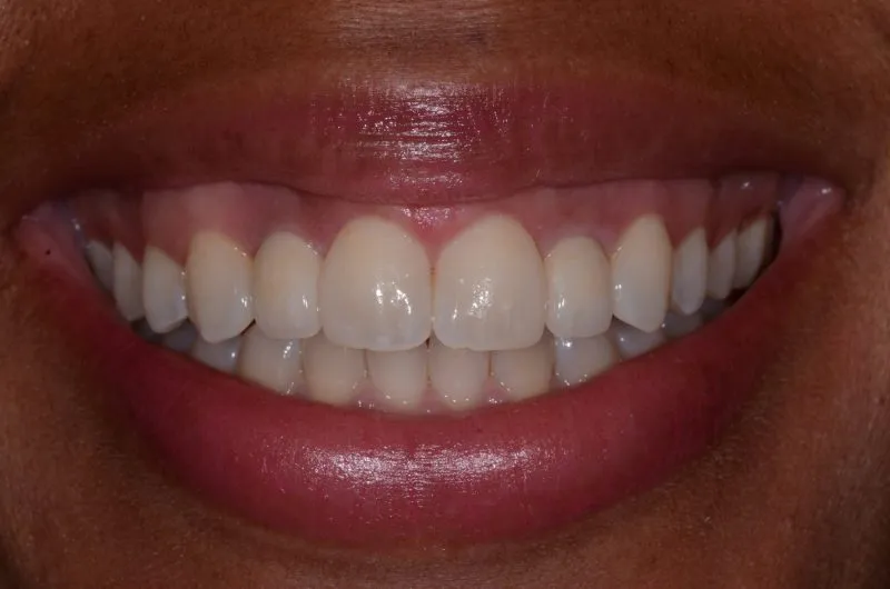 up-close image of patient's smile after porcelain crowns