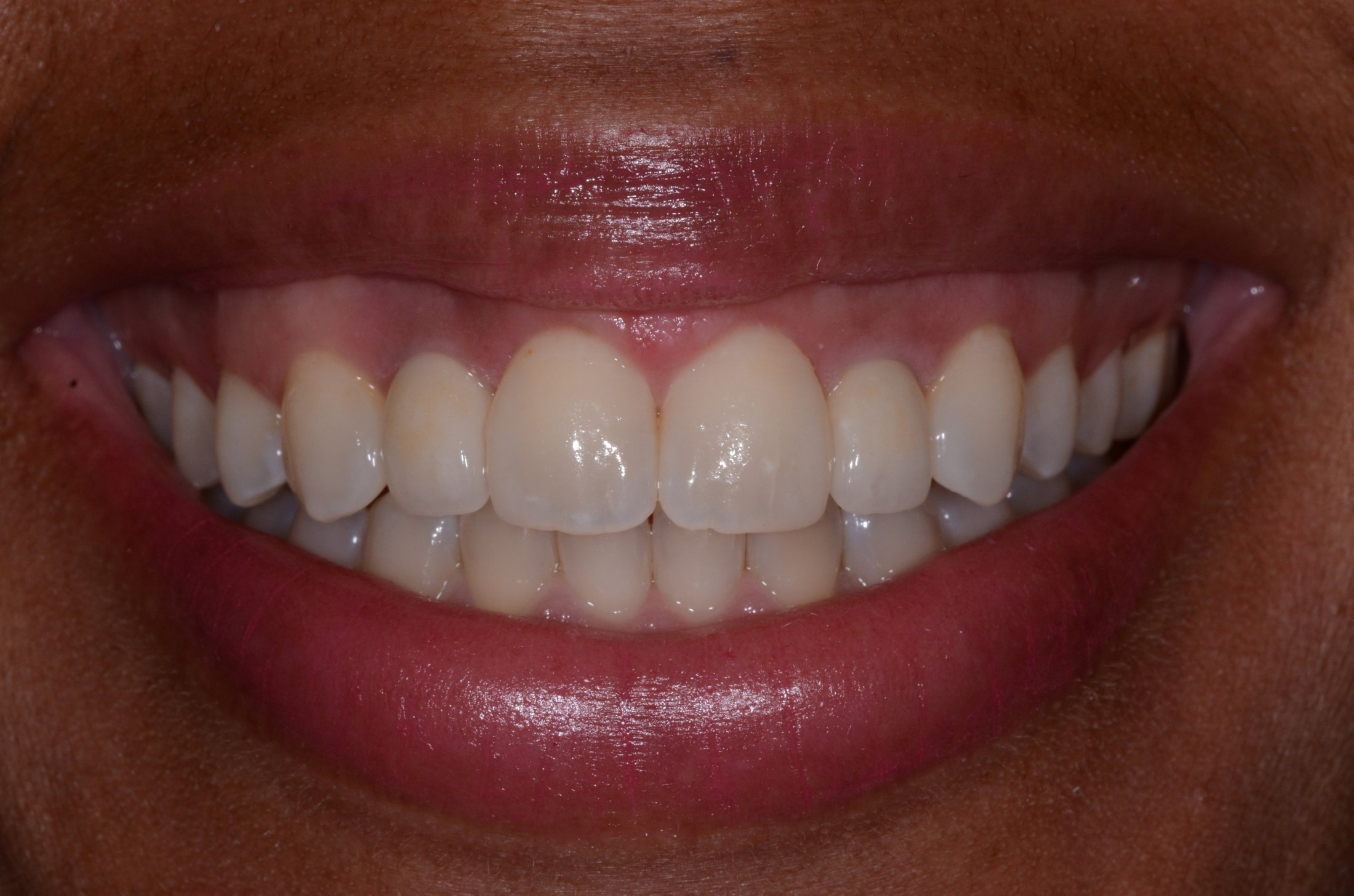 up-close image of patient's smile after porcelain crowns