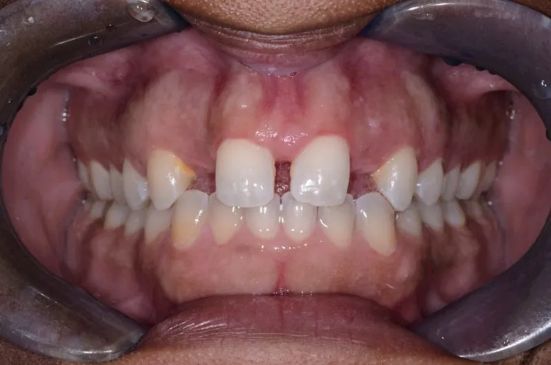 up-close image of patient's smile before porcelain crowns