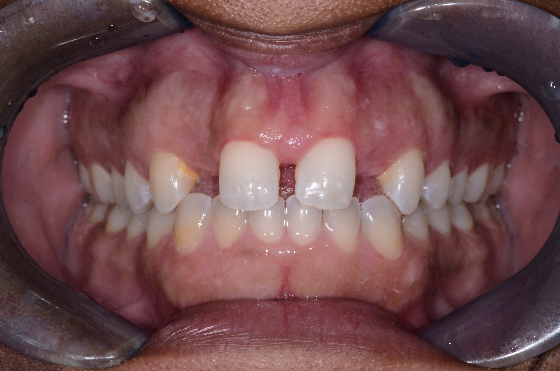 up-close image of patient's smile before porcelain crowns