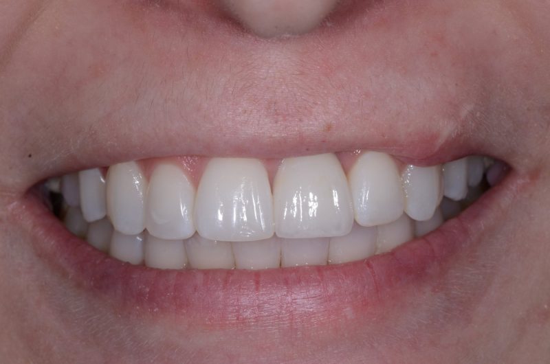 After Dental Implant was used to replaced front tooth