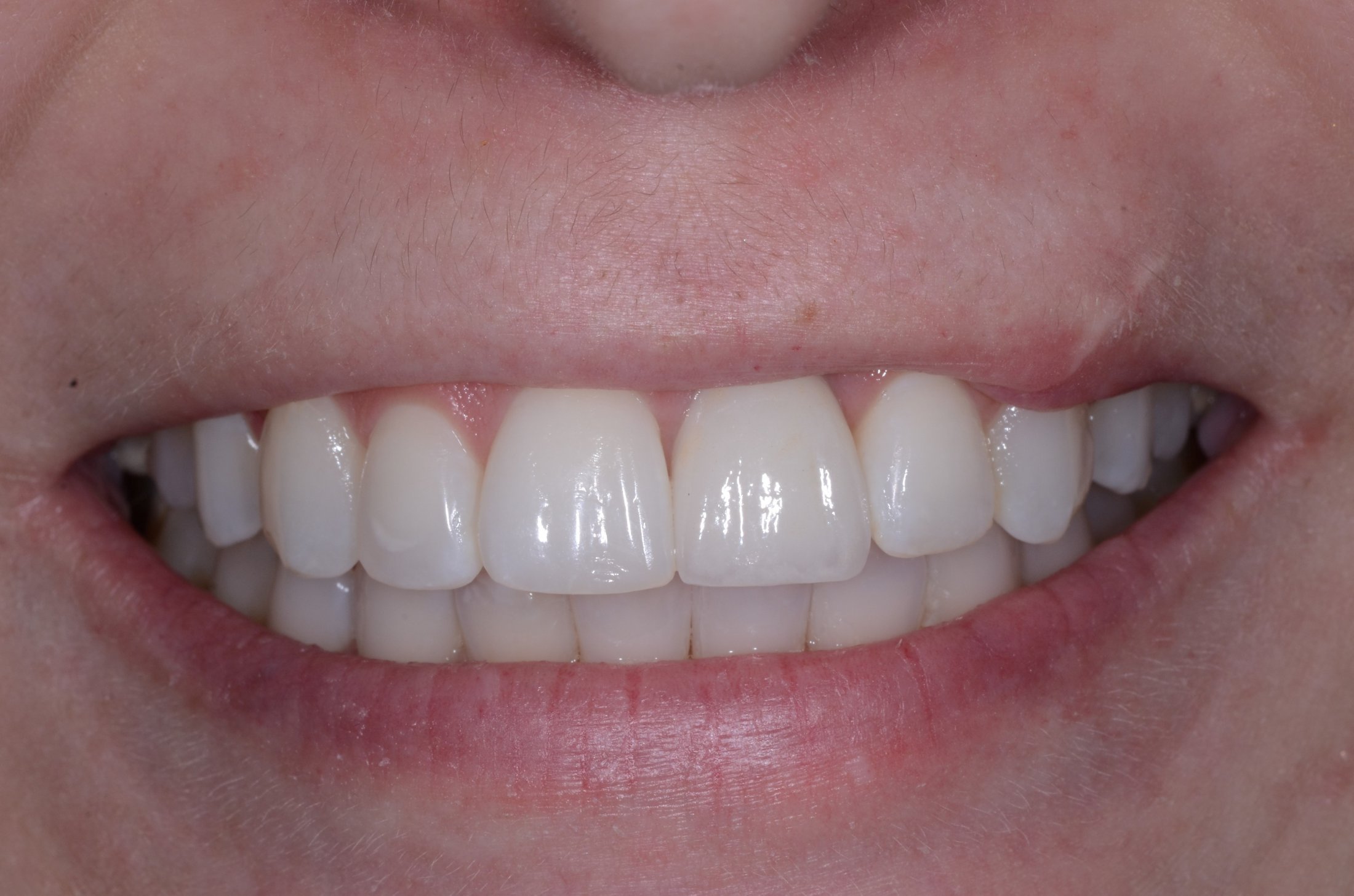 After Dental Implant was used to replaced front tooth