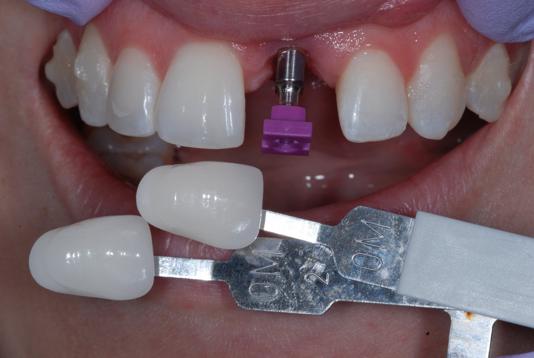 Patient's mouth with a dental implant but no crown