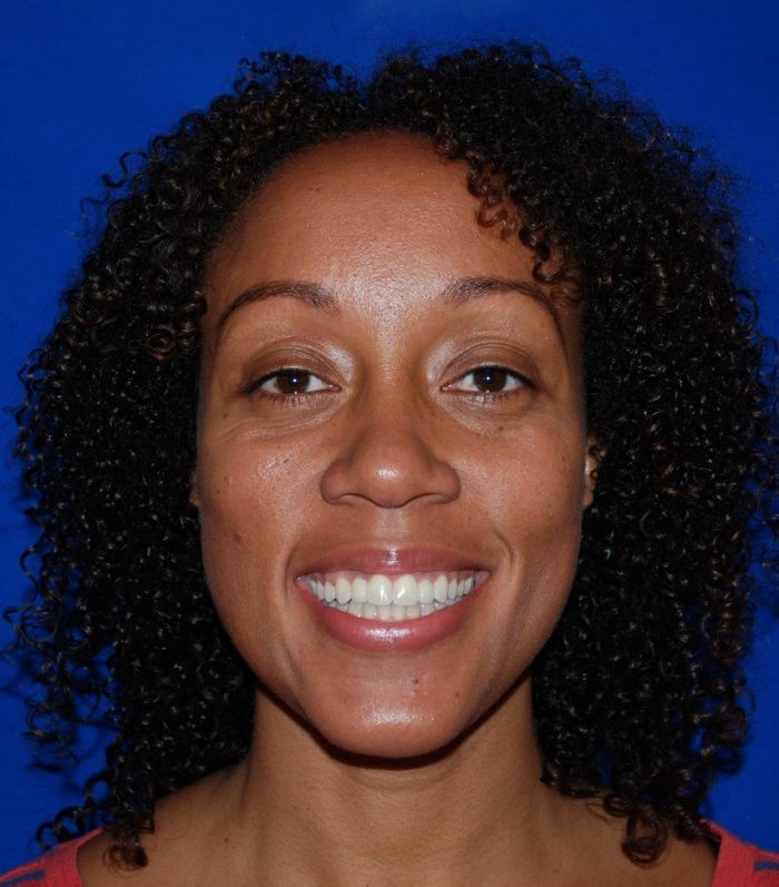 patient smiling after successful treatment at Fountaingrove Dentistry