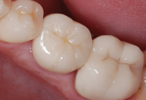 Patient's smile before dental implants