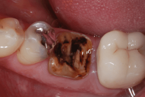 Patient's mouth before dental implants