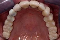 Patient's smile before dental implants