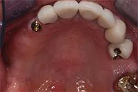 Patient's mouth before dental implants