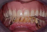 Patient's smile before dentures