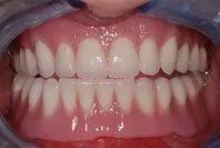 Patient's smile after dentures