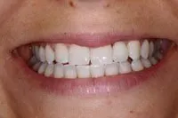 Patient's smile after cosmetic bonding