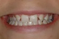 Patient's smile before cosmetic bonding