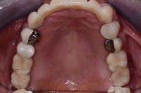 Patient's smile before dental implants