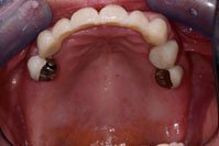 Patient's mouth before dental implants