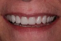 Patient's smile after dentures