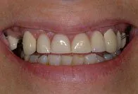 Patient's smile before dentures