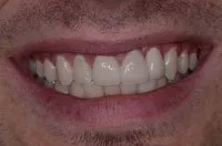 Patient's smile after a dental bridge