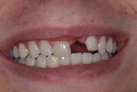 Patient's smile before a dental bridge