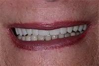 Patient's smile before dental implants