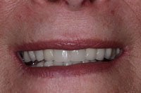 Patient's mouth before dental implants