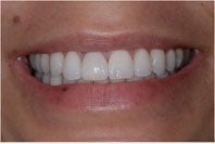 Patient's mouth before dental implants