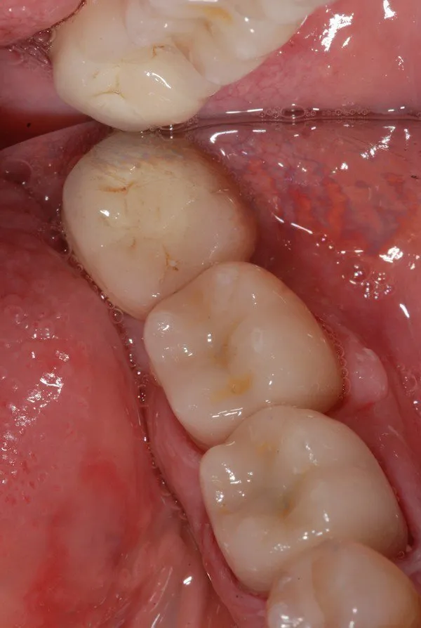 Patient's bottom teeth after CEREC crowns