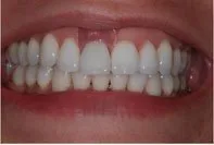 Patient's smile before dental implants