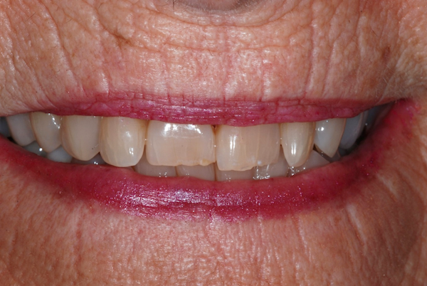 Patient's smile before dental crowns