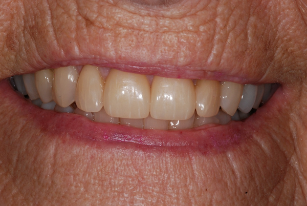 Patient's smile after dental crowns