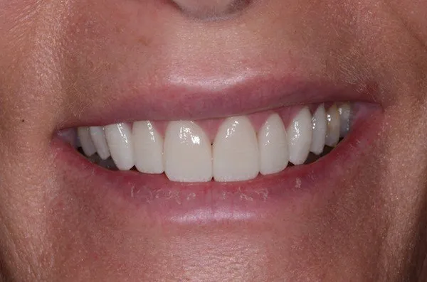 up-close image of patient's smile after dental treatment