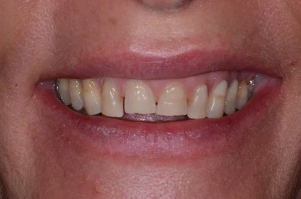 up-close image of patient's smile before dental treatment