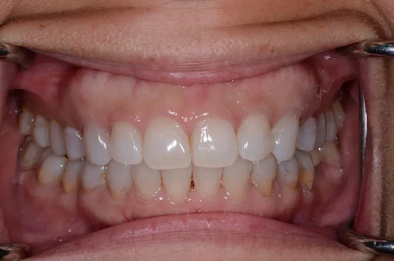 Patient's teeth after Invisalign