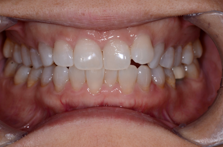 Patient's teeth before Invisalign
