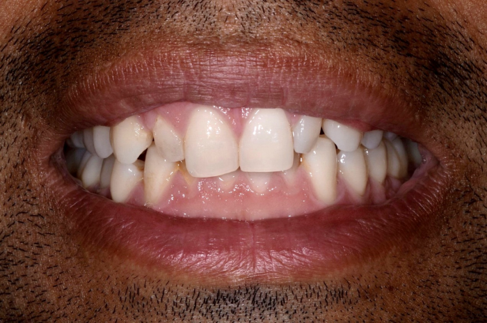 Patient's smile before cosmetic bonding