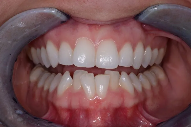 Patient's teeth before Invisalign