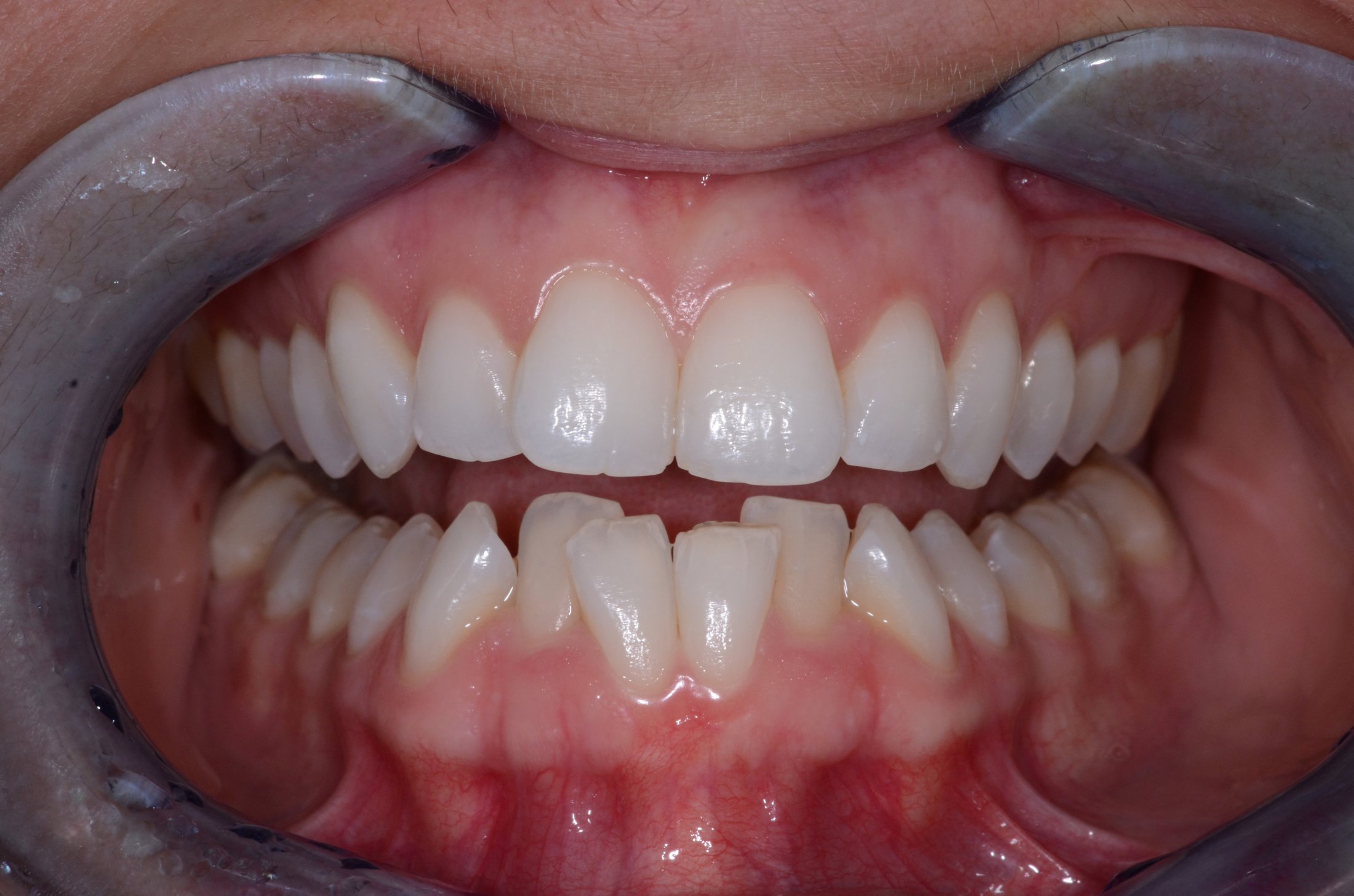 Patient's teeth before Invisalign