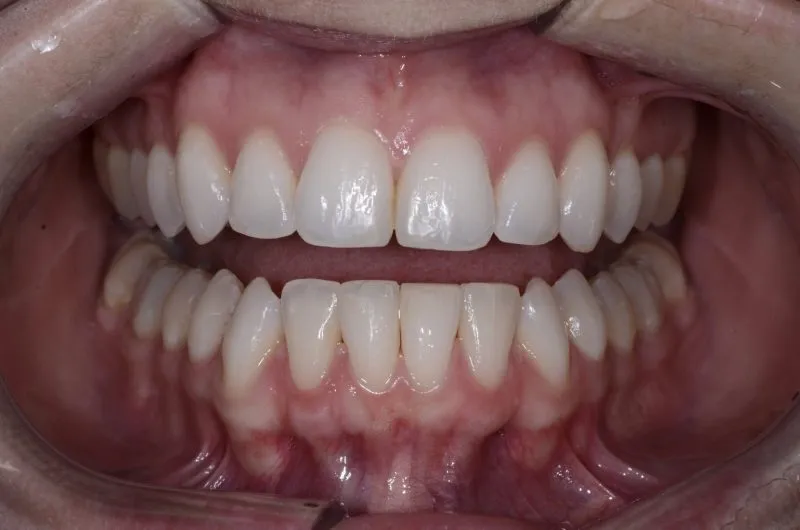 Patient's teeth after Invisalign