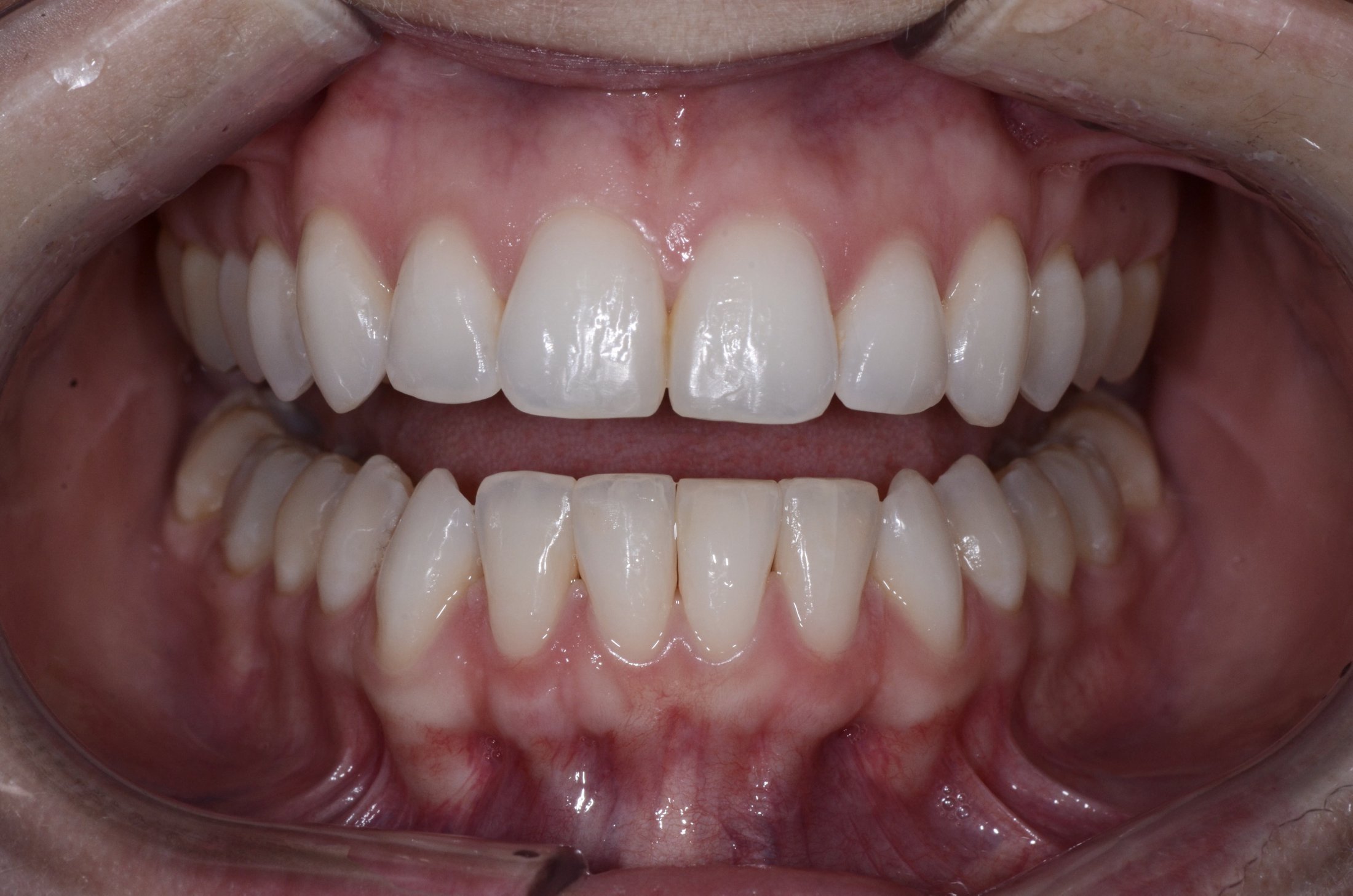 Patient's teeth after Invisalign