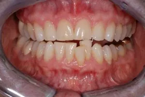 Patient's teeth before Invisalign