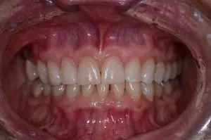 Patient's teeth after Invisalign